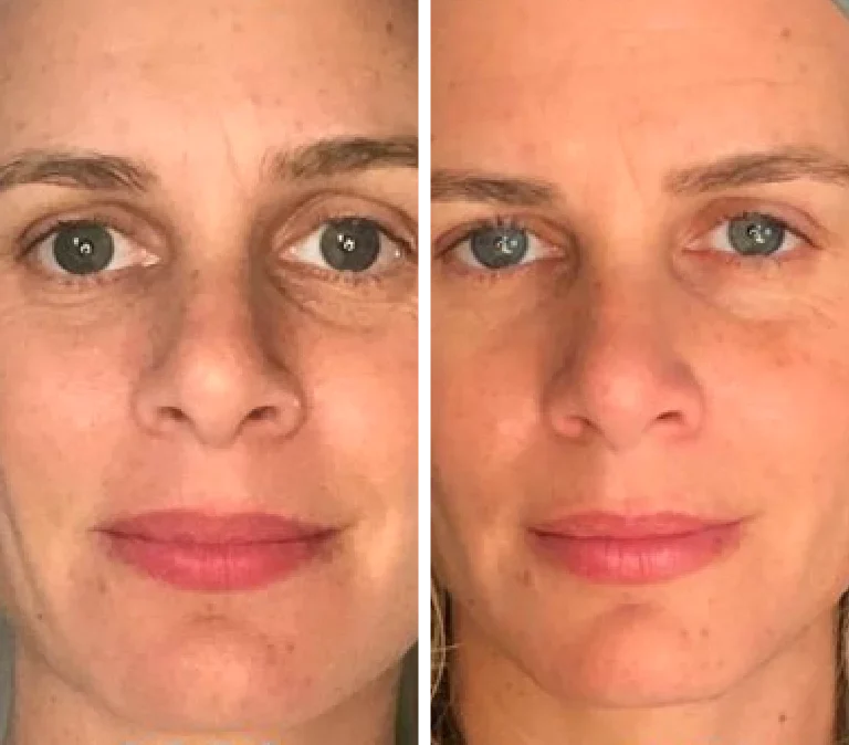 Antes y después - piel más firme y radiante con masajeador de cristal frío